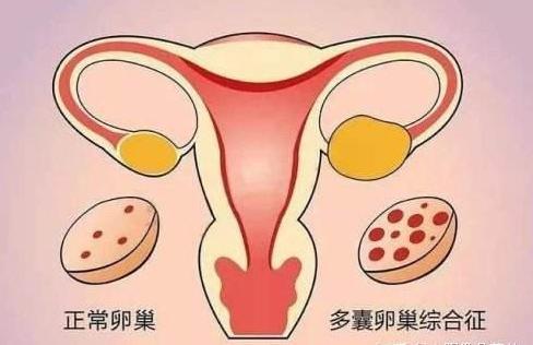 多囊卵巢综合征自然受孕几率大吗？注意调节生活方式可提高受孕几率