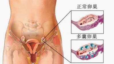 多囊卵巢人工受精的成功率不高，采取适当措施可有效提高