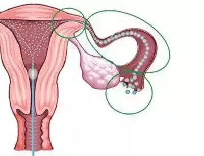 输卵管造影真实经历有哪些？