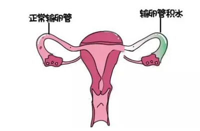 输卵管积液是怎么造成的？