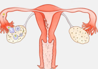 多囊卵巢症与长期生闷气有关，早期发现症状要及早就医