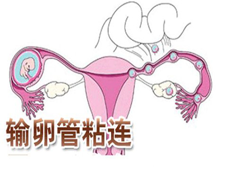 输卵管粘连为确保试管婴儿条件理想，专家建议先治疗