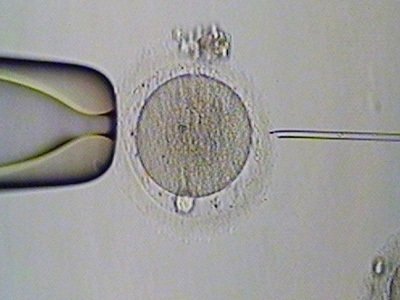 睾丸穿刺试管婴儿，一种有效的生殖技术