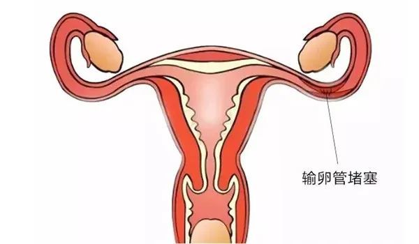 什么是输卵管不通，是一种不孕症且积极治疗