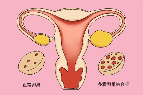 多囊卵巢综合征在临沂做试管，能报销吗？