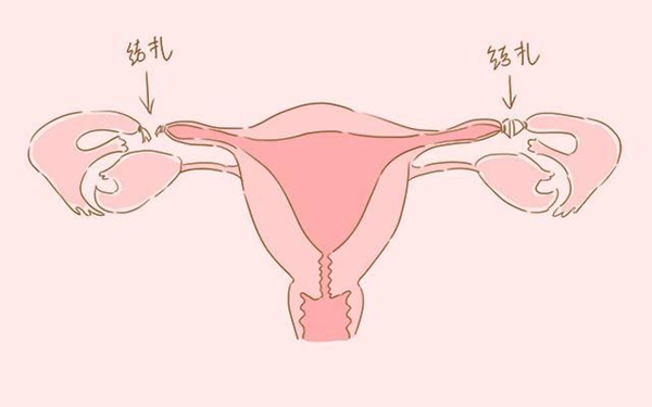 输卵管不通畅症状解读，致使女性不孕的主因之一