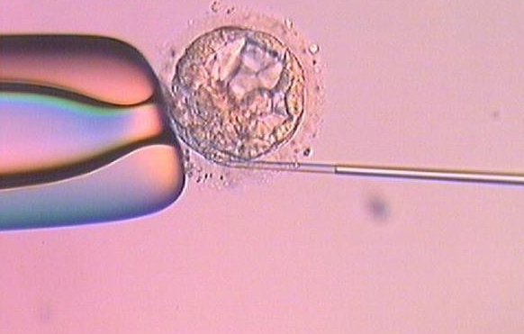 输卵管过长做试管婴儿适合哪种促排方案?