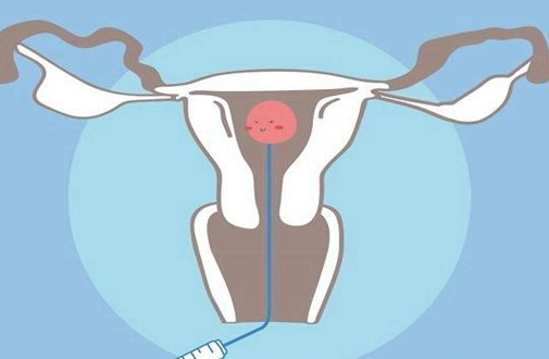 试管婴儿的辅助生殖方式有什么特点？