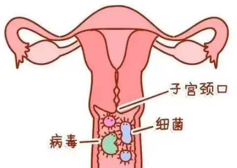 有什么办法能够治疗女性子宫糜烂的情况？