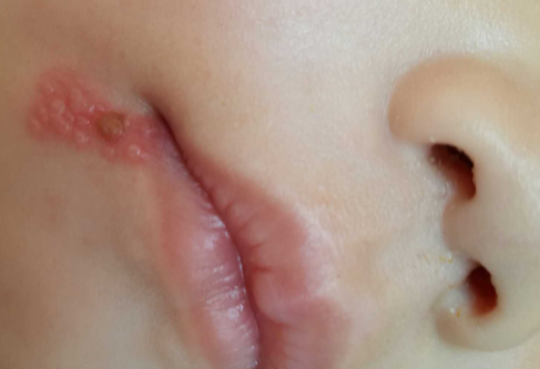 新生儿嘴角起白色的泡是什么原因导致的？怎样进行治疗？
