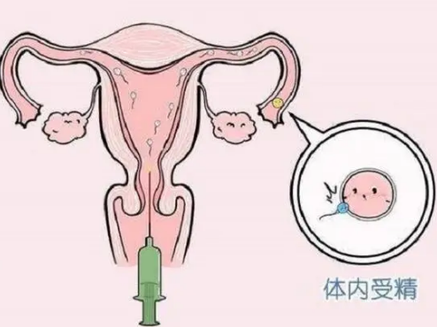 人工受精也是一种辅助生育方式，在长沙做一次治疗的费用需要这个数