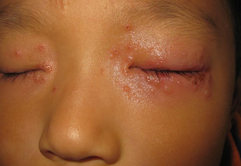 新生儿眼皮上红肿水泡是一种常见的情况，日常生活中一定要注意护理