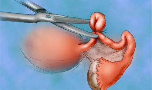 输卵管结扎对试管婴儿成功率有影响，科学的治疗可以提高试管的成功率
