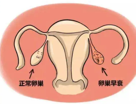 卵巢早衰是一种不可逆的疾病，这三种方式治疗的效果最好