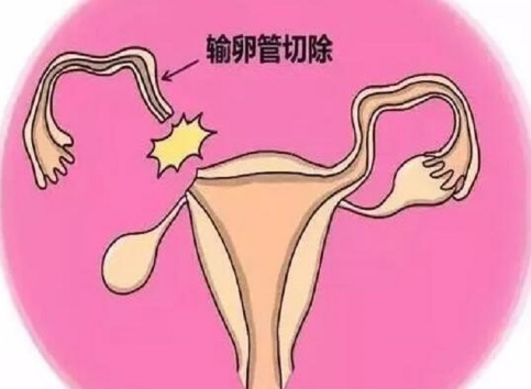 输卵管切除一侧后怀孕几率略有下降，但并不意味着女性无法怀孕