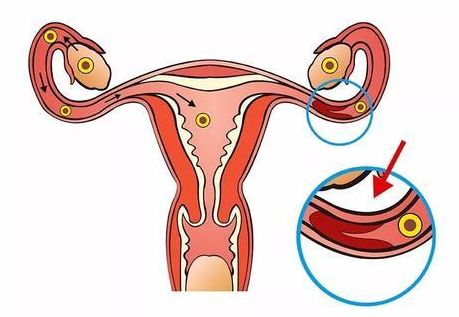 输卵管粘连是常见的妇科疾病，外科、中药等均有办法可以治疗