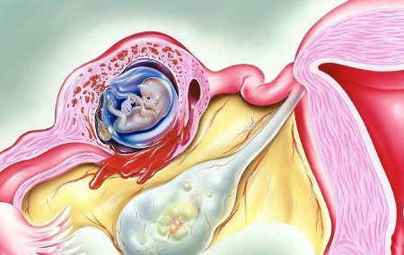输卵管粘连的患者做试管会出现宫外孕的情况吗？