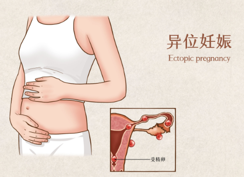 试管移植后也会出现宫外孕的情况，这些秘诀能降低宫外孕的风险