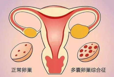 多囊卵巢能不能做试管？试管婴儿技术是值得尝试的选择