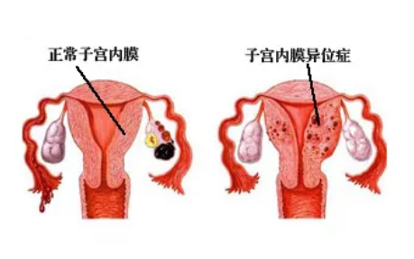 子宫内膜异位做试管会对成功率有影响，但试管是患者最佳生育的方式