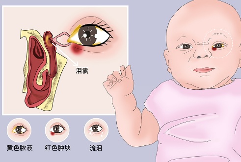 新生儿泪管阻塞是宝宝常见的疾病，合理和预防的方法全部总结在本文