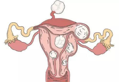 轻微子宫肌瘤女性申请做试管婴儿的流程是什么样的？