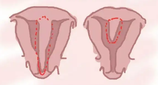 子宫纵隔的女性做三代试管有危险吗？