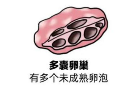 多囊卵巢综合征在惠州做试管婴儿是明智的选择吗？