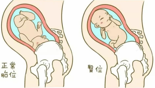 胎位头位是孕晚期的理想胎位吗？