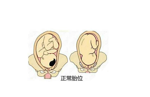 胎位rop什么胎位？对胎儿有什么影响？