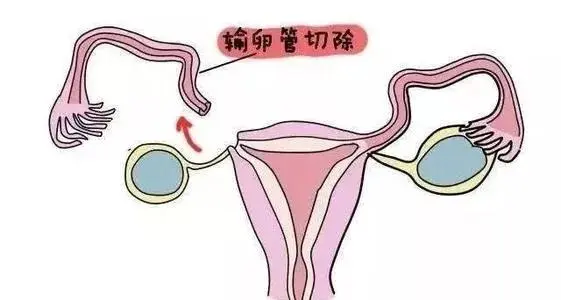 输卵管切除后是否可以进行试管婴儿治疗？有什么方案？