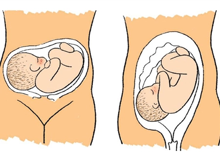 胎位LSA是什么？对胎儿和孕妇有何影响？