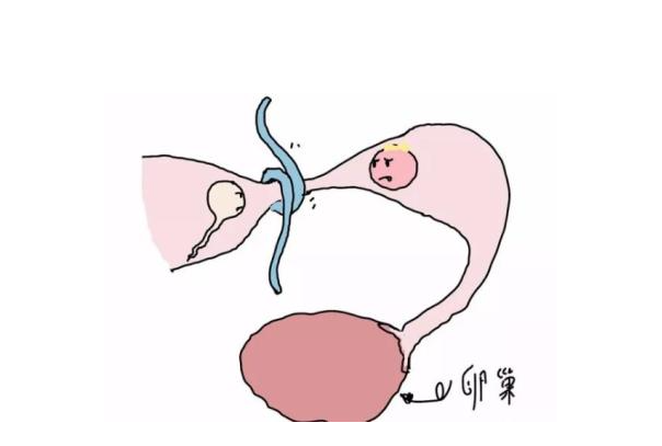 输卵管缠绕是如何引起的？有哪些可能的原因？