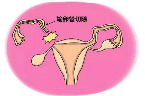 双侧输卵管切除试管移植后受孕的几率大吗？