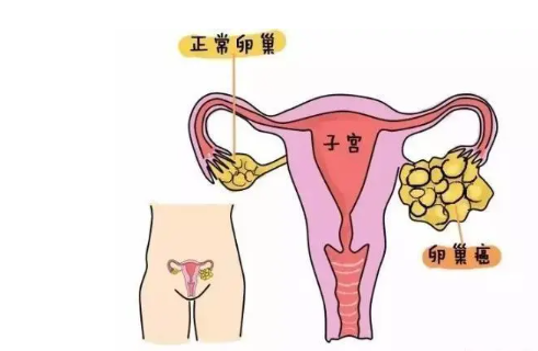 卵巢位置高不好取卵怎么办?卵巢位置偏高做试管有影响吗?