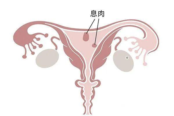 子宫内膜结核在香港医院做三代试管婴儿选性别多少钱？