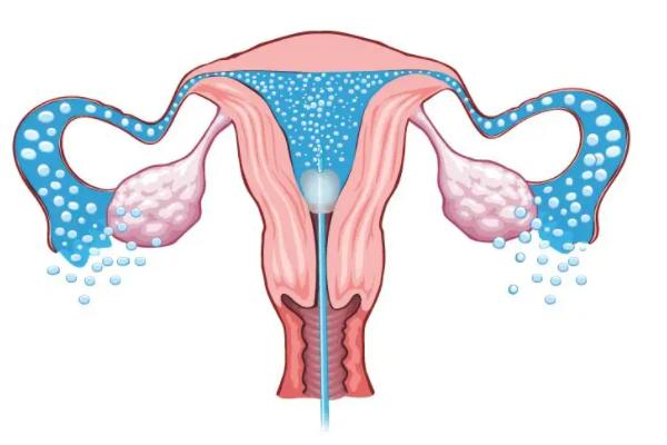 输卵管积水3cm做试管婴儿用超长方案促排流程步骤是什么？