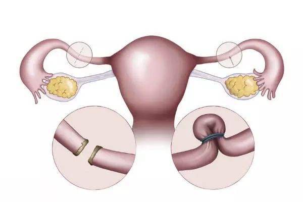 输卵管问题试管助孕生的孩子体质会比较弱吗？
