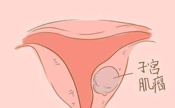子宫肌瘤2cm试管移植后受孕的几率大吗？