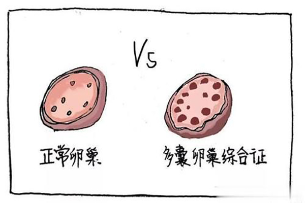 多囊卵巢综合征在天津做试管能一次成功吗?