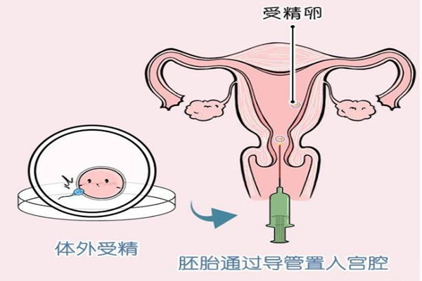 试管婴儿移植前憋尿的作用是什么？如何影响移植成功率？
