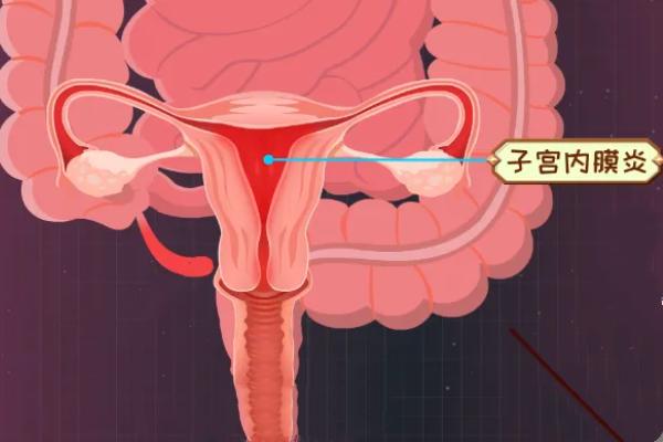 子宫内膜炎在杭州做试管能一次成功吗？