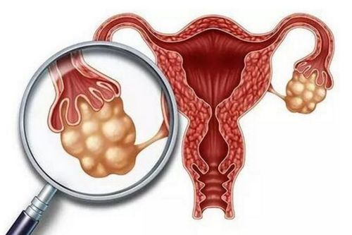 试管卵巢扭转是怎么回事？