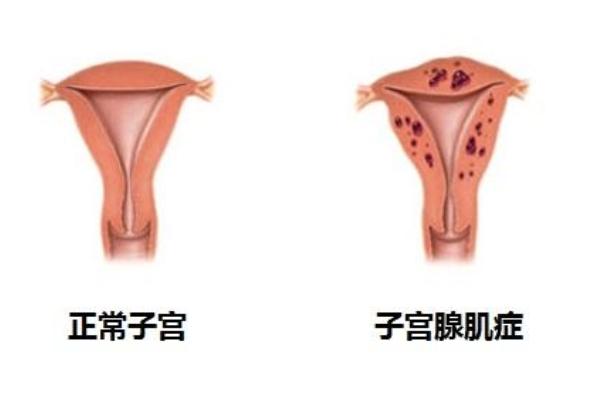 子宫腺肌症在武汉做试管能一次成功吗？