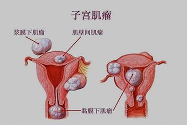 子宫肌瘤在福州做试管要多少钱？哪个医院做更有保障？