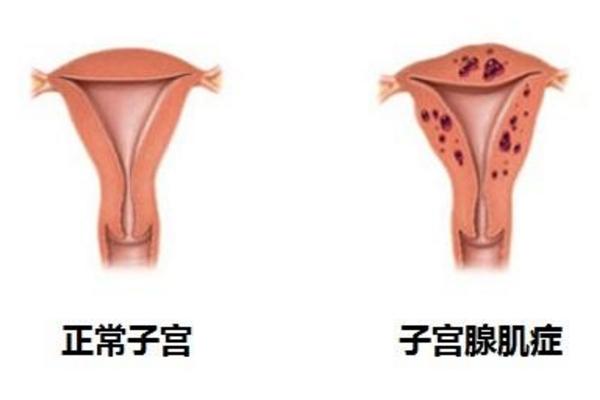 子宫腺肌症在长沙做试管婴儿怎么样？可以移植2个囊胚吗?