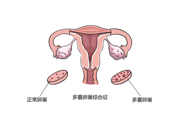 多囊卵巢综合征在嘉兴做试管要多少钱？