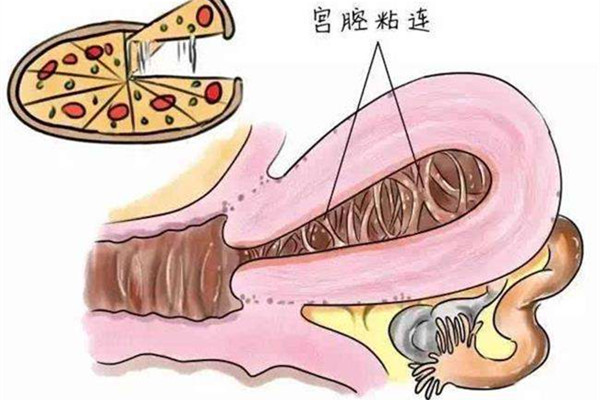 宫腔粘连在深圳做试管要多少钱？移植能着床吗？