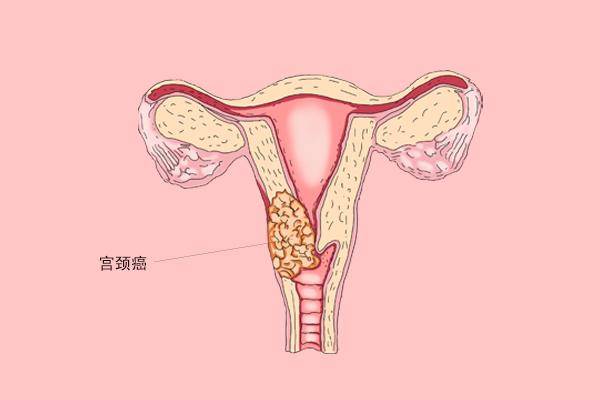 子宫内膜息肉试管多久可以移植？需要做宫腔镜吗?