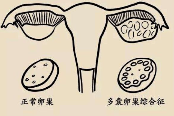 多囊卵巢综合征试管后能怀孕吗？做试管婴儿该如何调理？